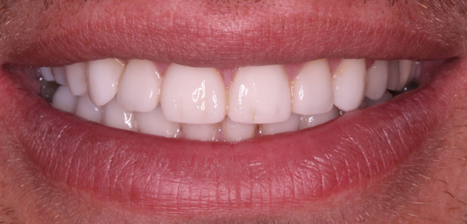 Dental Composite Bonding (Cosmetic) | Bupa Dental Care UK